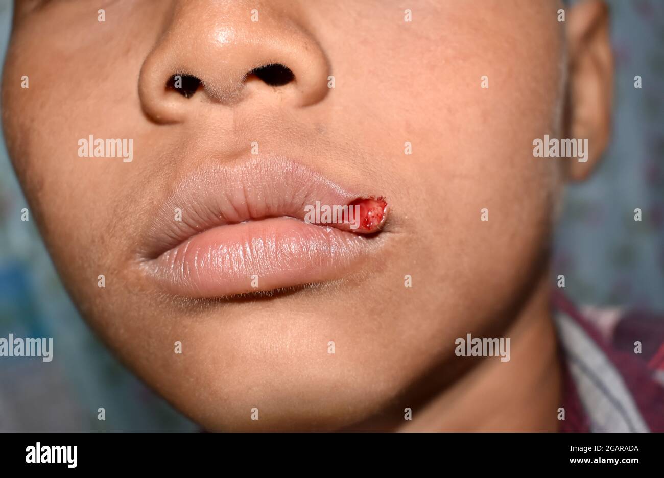 Small lacerated wound in lip of Asian, child. Closeup view. Stock Photo