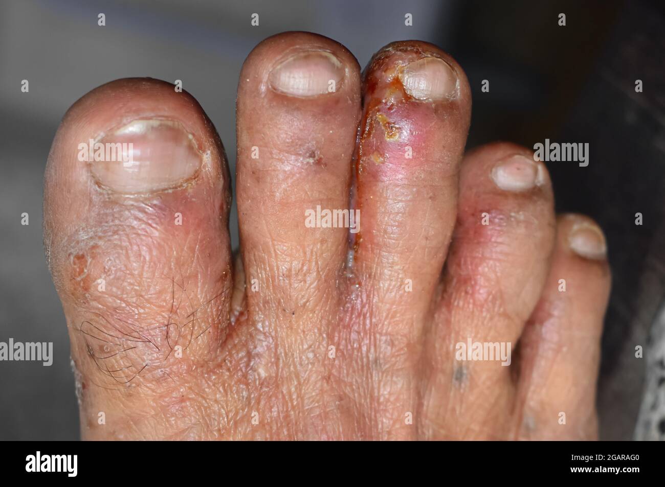 Scabies Infestation with secondary or fungal infection or tinea pedis in foot of Southeast Asian man. Stock Photo
