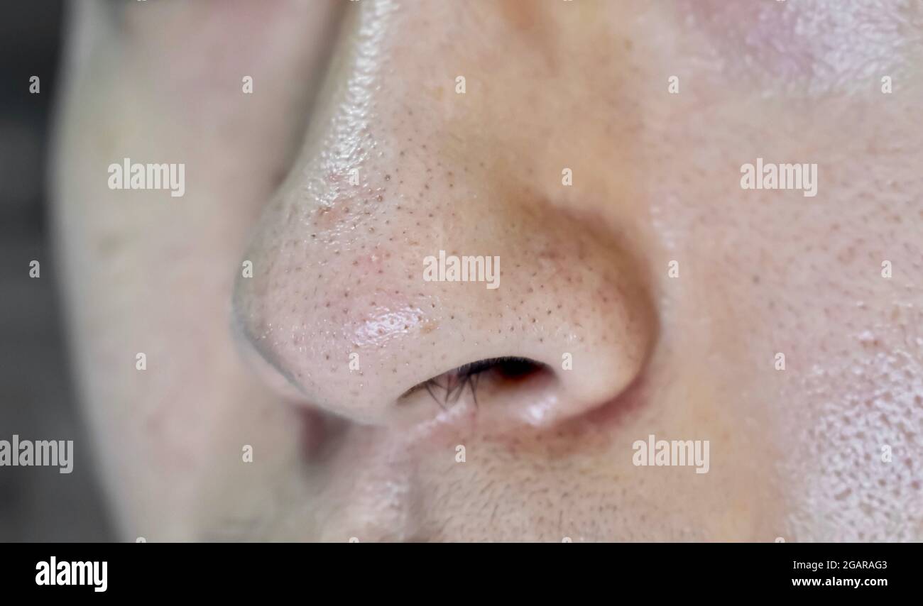 Blackheads or black heads on nose of Asian man. They are small bumps that appear on skin due to clogged hair follicles. Closeup view. Stock Photo