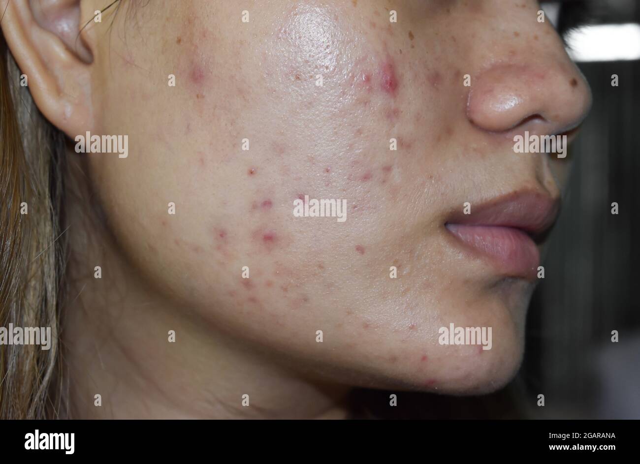 acne vulgaris and scars over whole face of Southeast Asian woman. Acne occurs when hair follicles become plugged with oil and dead cells. It causes wh Stock Photo