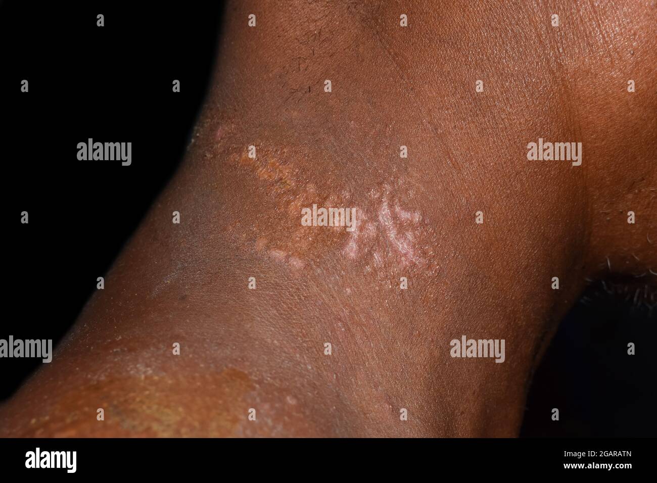 Tinea versicolor or pityriasis alba in neck of Southeast Asian man. Isolated on black. Stock Photo