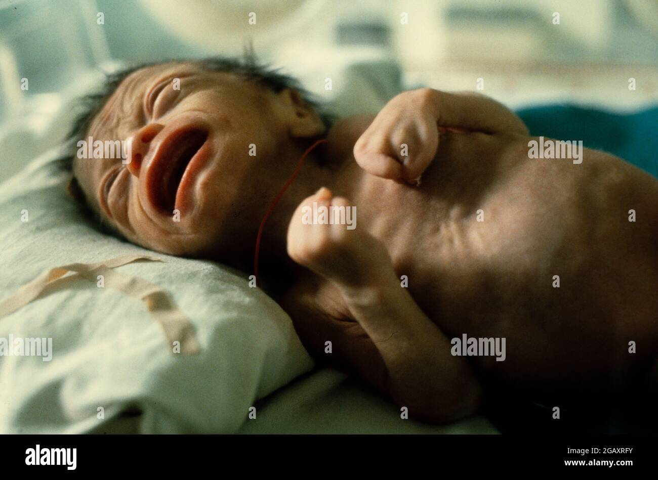 Pham Xuan Lo, born on 10th June 1980.   The baby's father was sprayed with Agent Orange  by US warplanes while a soldier in the south. This is the family's first child. This premature baby has  nternal and is only expected to live for one more week. Stock Photo