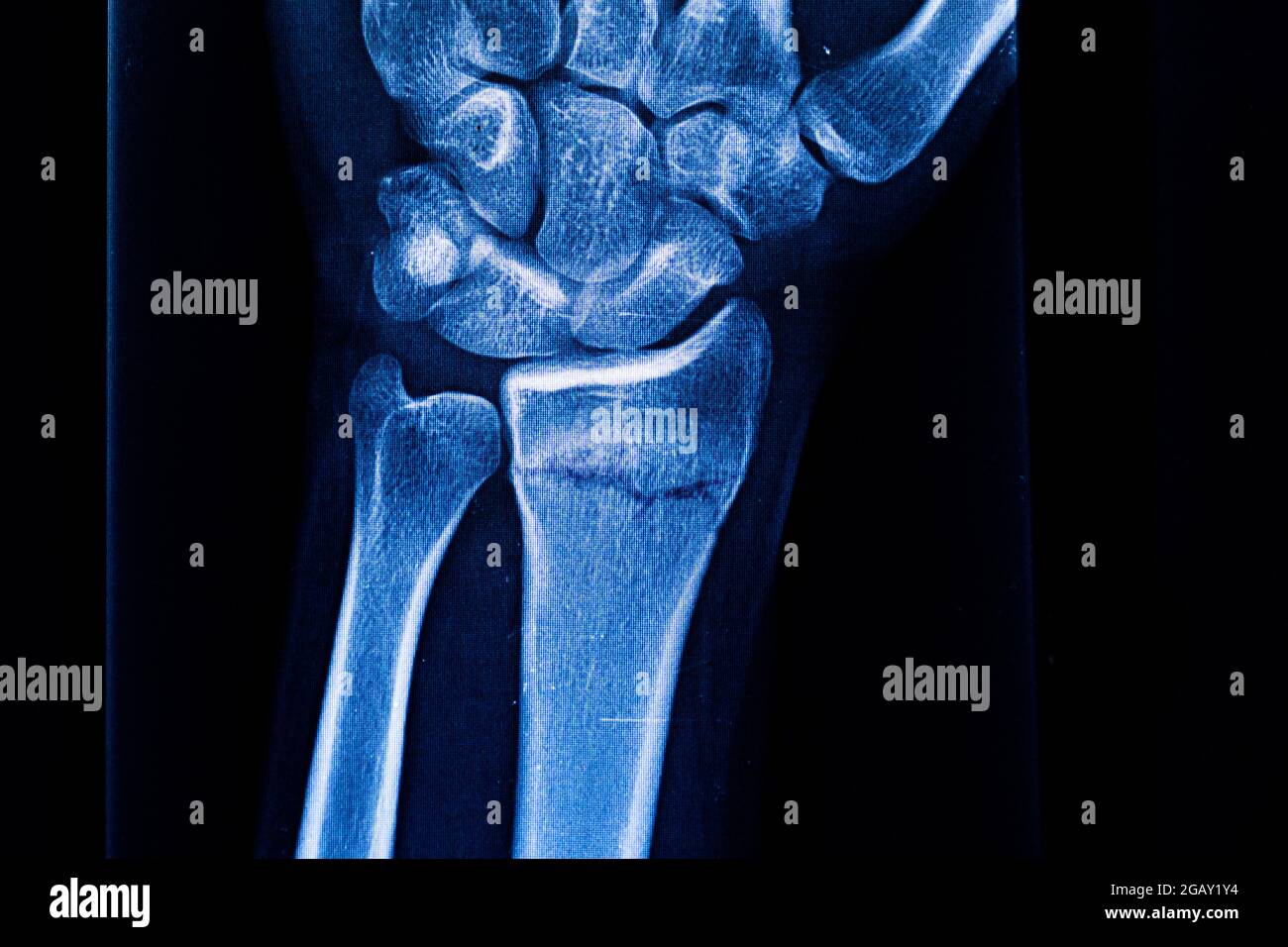Radiography examination of radius fracture. Xray human arm. Xray of