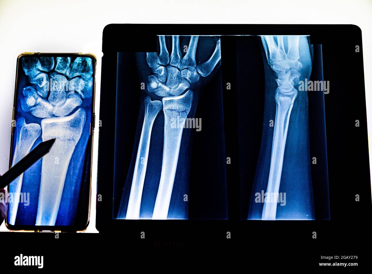 Radiography examination of radius fracture with mobile phone. Xray