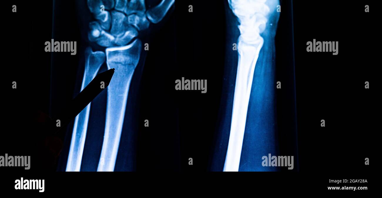 Radiography examination of radius fracture. Xray human arm. Xray of