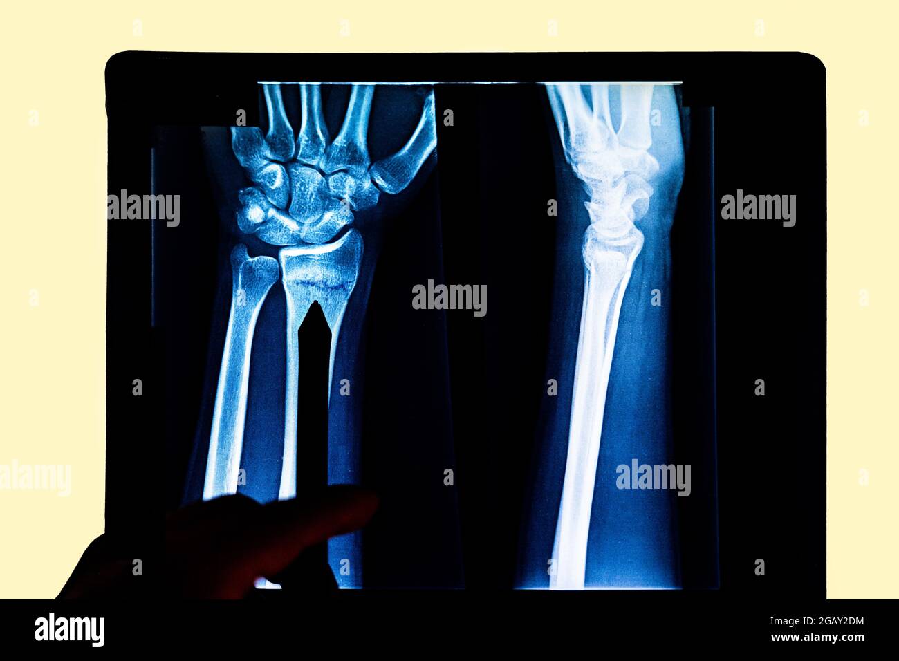 radiography examining x-ray film of patient's arm pointing to radius fracture. X-rayed human hand. X-ray of hand bones. Medical technology radiography Stock Photo