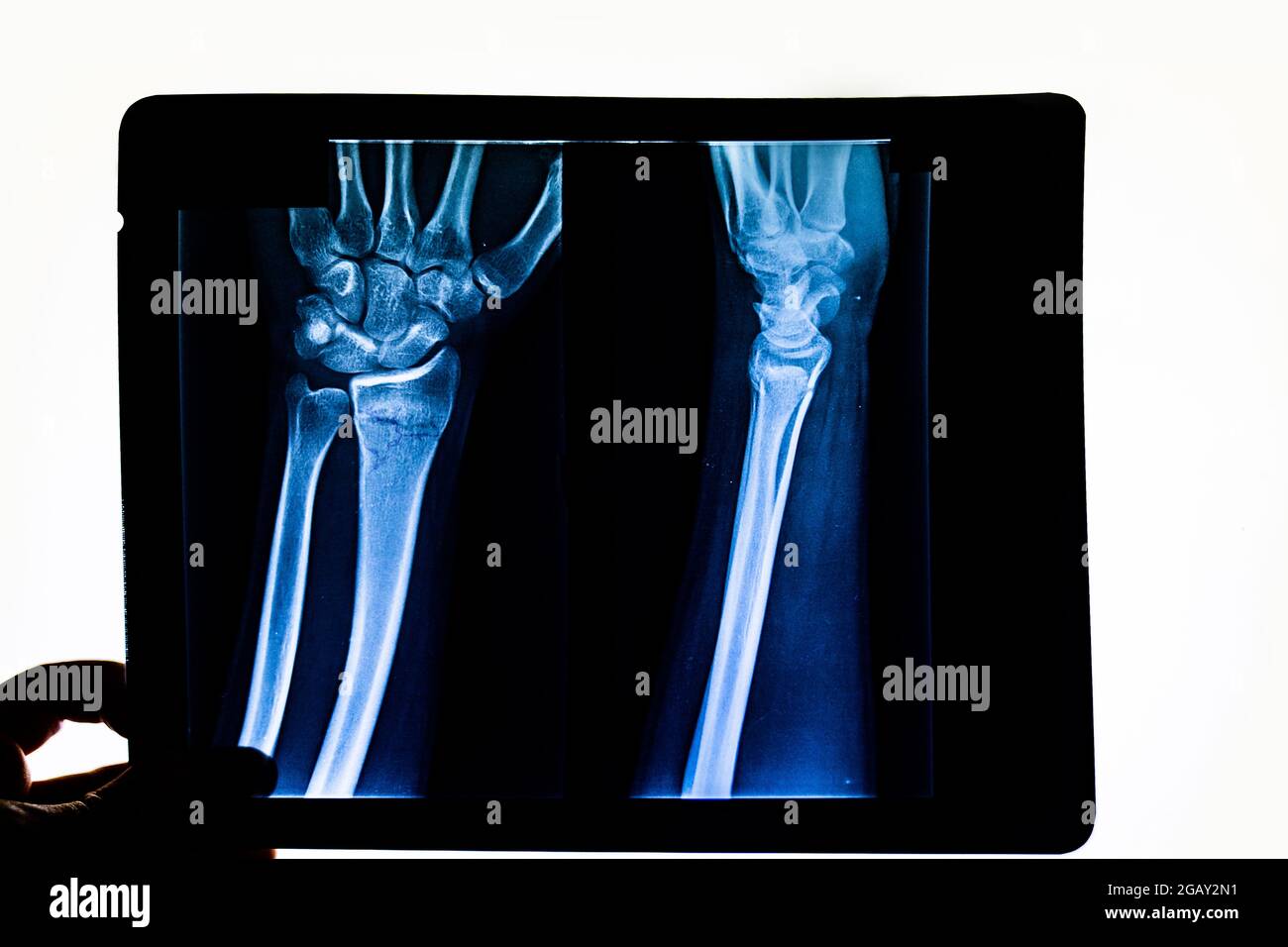 Doctor checking radiography examining x-ray film of patient's arm pointing to radius fracture. X-rayed human hand. X-ray of hand bones. Medical techno Stock Photo