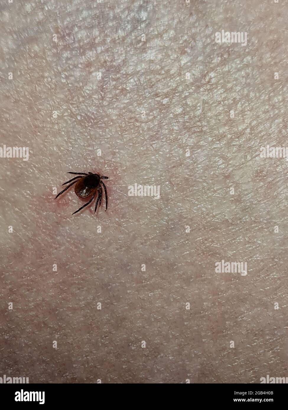 Tick with its head sticking in human skin, red blotches indicate an