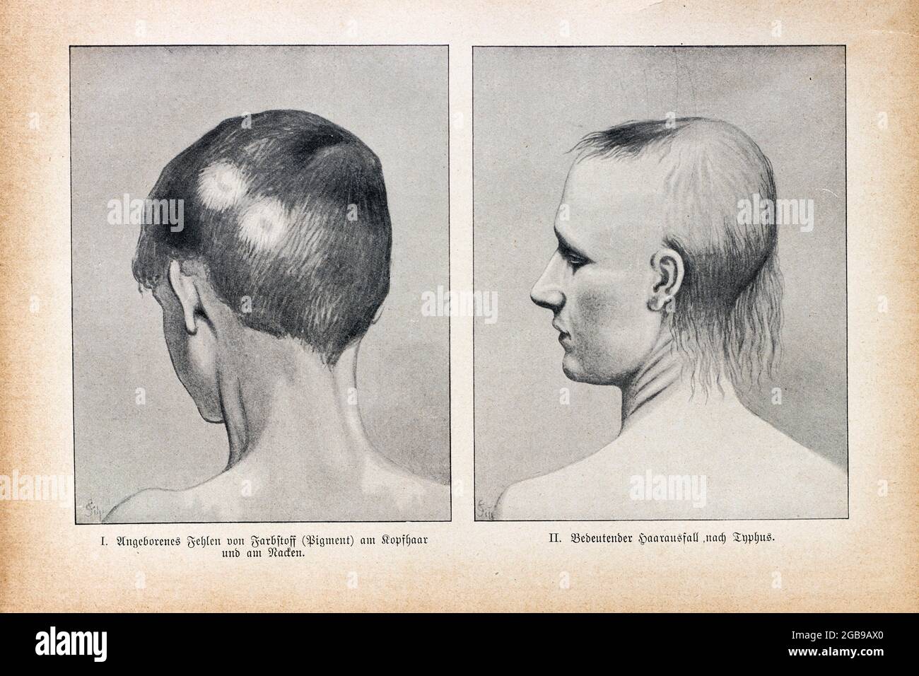 Absence of dye on the hair of the head and significant hair loss after typhoid fever, Der praktische Hausarzt, Ein Weg zur Gesundheit, 1901, Breslau Stock Photo