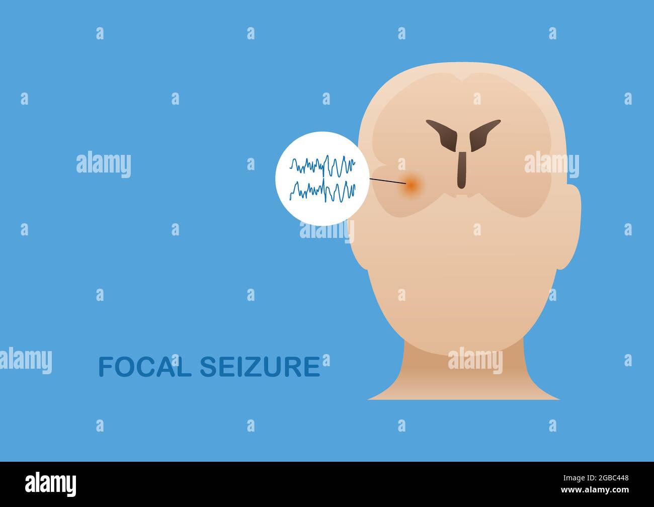 Temporal lobe epilepsy. Vector illustration of human focal seizure. Abnormal brain waves arising from the side of brain Stock Vector