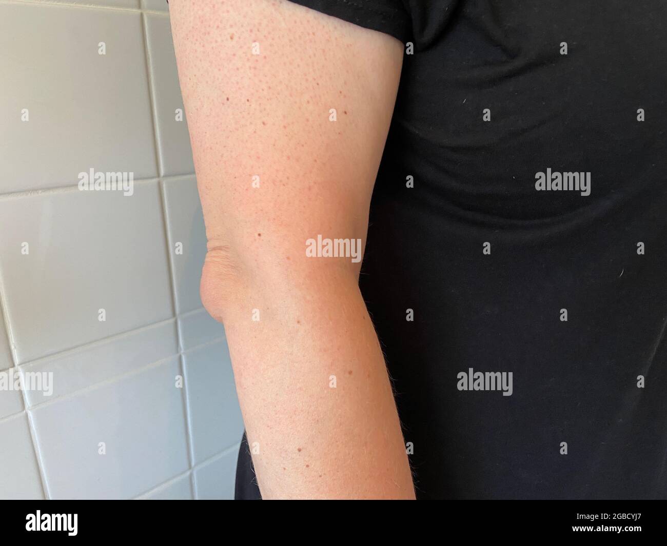 olecranon bursitis is sometimes called “Popeye’s elbow.” Bursitis is a