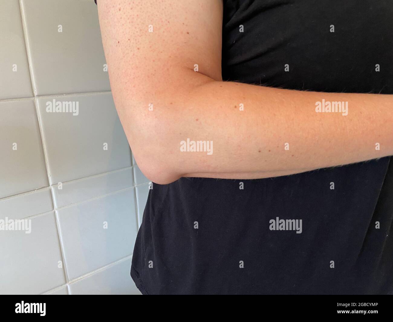 olecranon bursitis is sometimes called “Popeye’s elbow.” Bursitis is a