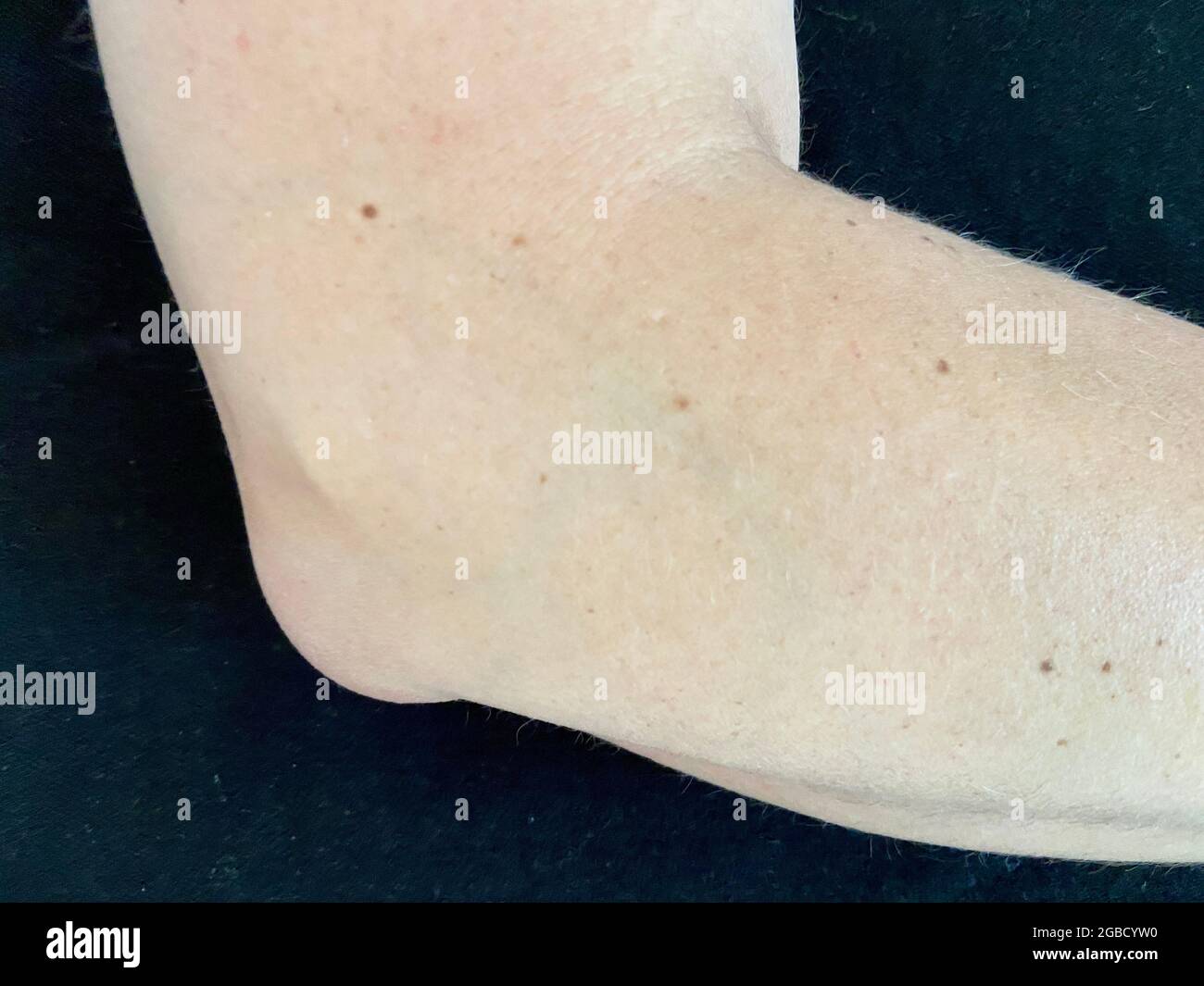 olecranon bursitis is sometimes called “Popeye’s elbow.” Bursitis is a swelling of the bursitis