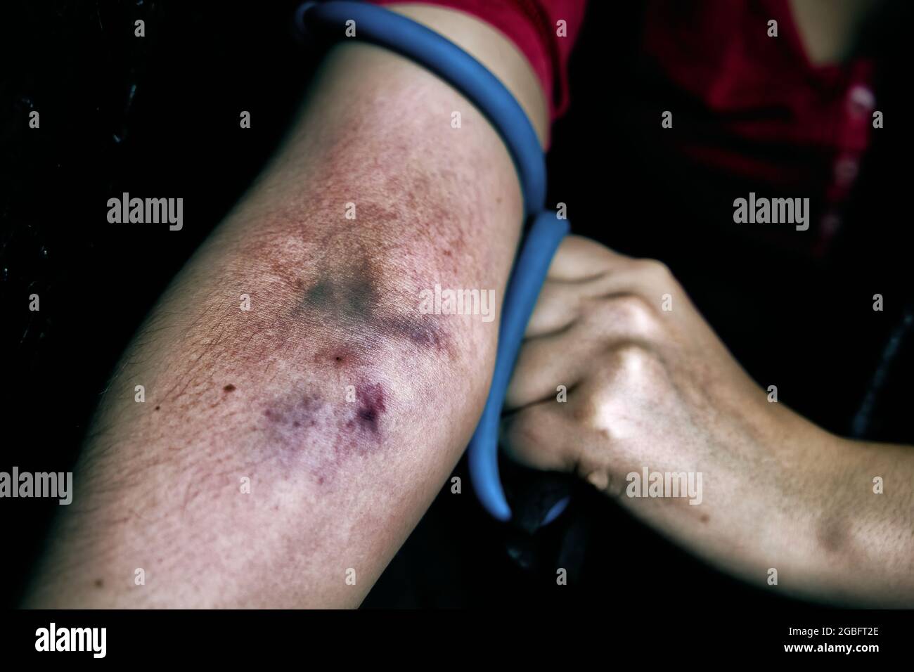 Bruise On Back Woman Extensive Hematoma Stock Photo 1139159858