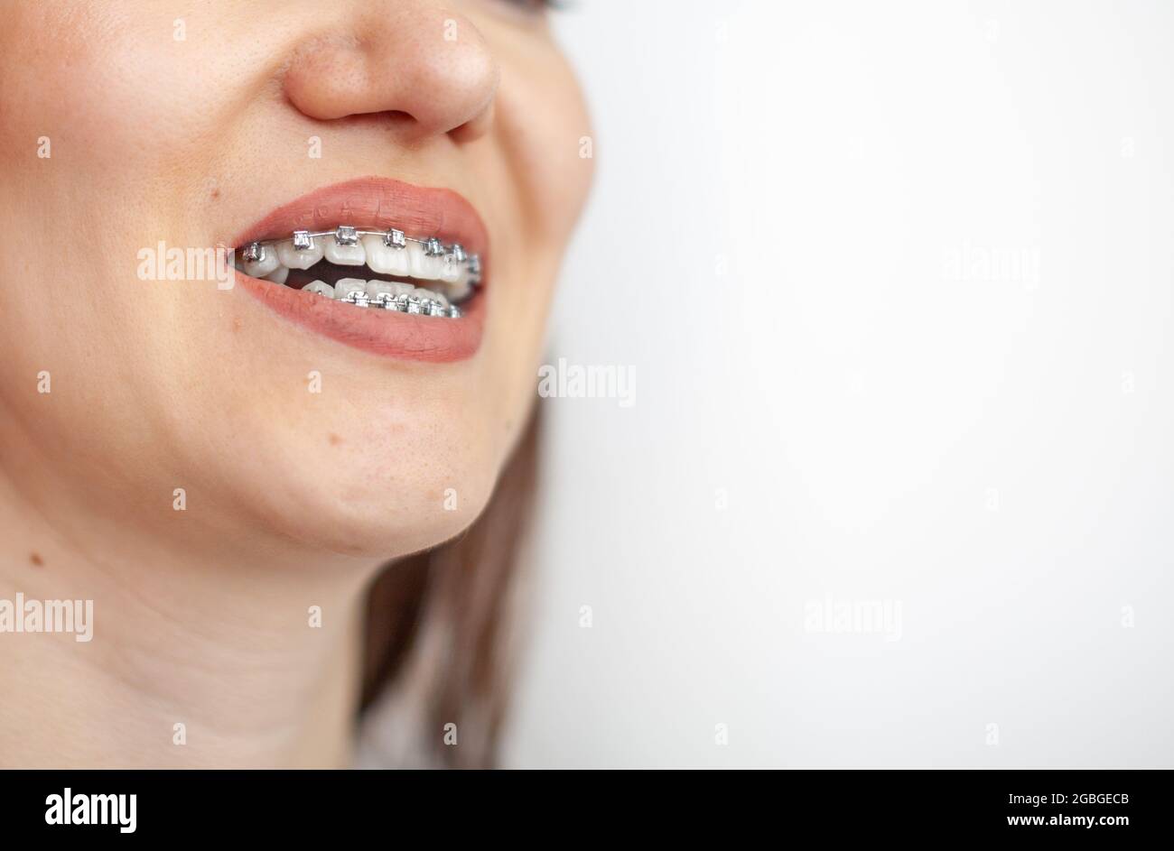 The smile of a young girl with braces on her white teeth. Teeth