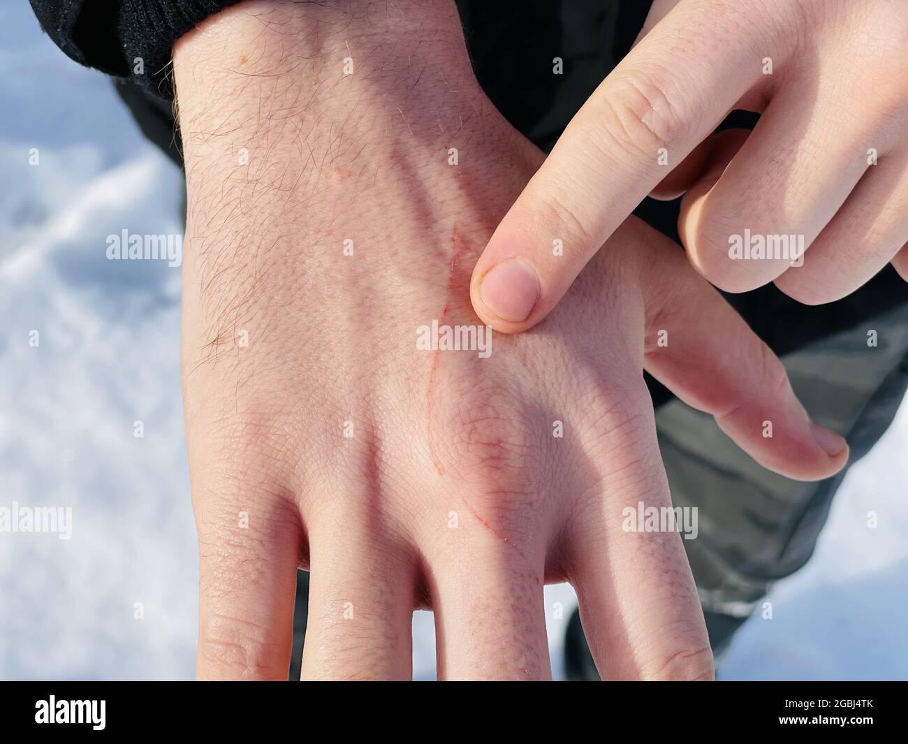 Scratch In Hand scratch on a hand, close up Stock Photo - Alamy