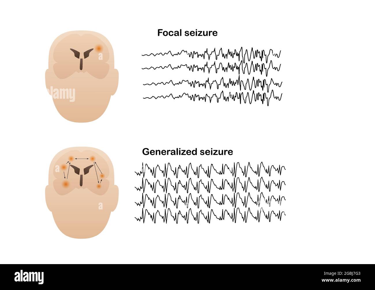 Vector illustration of seizure types demonstrating by onset and brain waves. Focal seizure and generalized seizure. Electroencephalograhy or EEG of se Stock Vector
