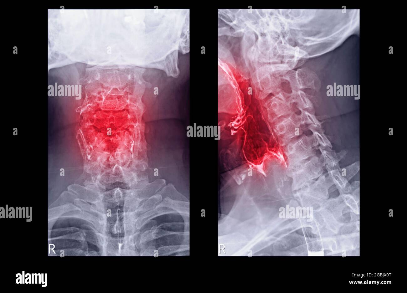 Esophagram or Barium swallow AP and Lateral view  showing esophagus for diagnosis GERD or Gastroesophageal reflux disease and Esophageal cancer. Stock Photo
