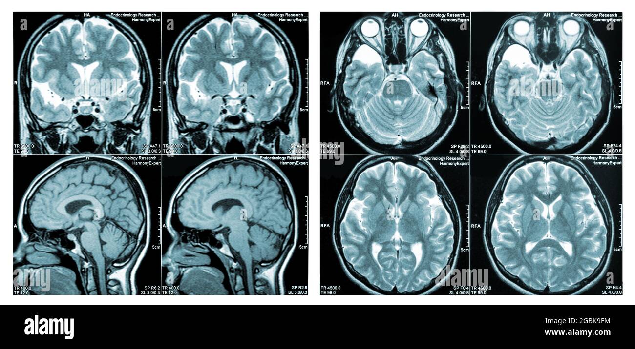 MRI Scan image of a human brain showing all main multiple sclerosis Stock Photo