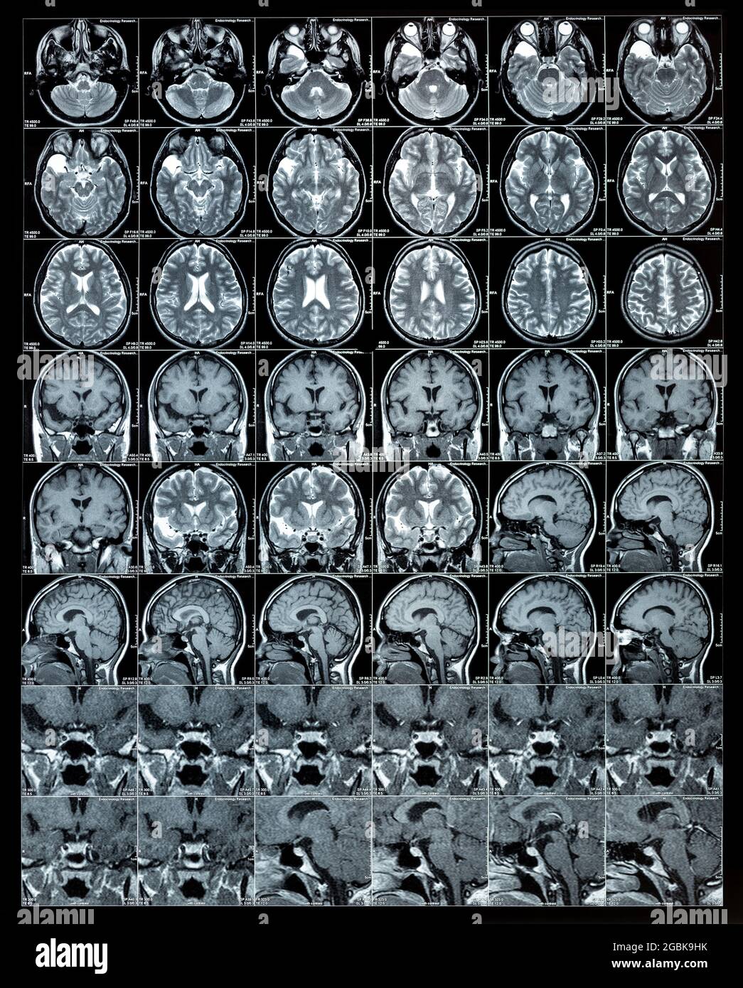 MRI brain scan or magnetic resonance image results, neurology concept, diagnostic Stock Photo