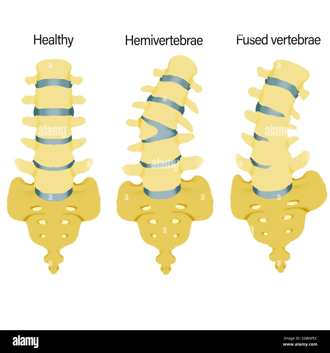 Deformity Spinal Cord Stock Photo