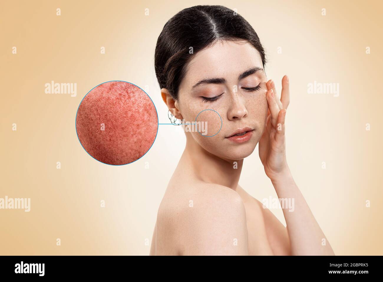 Portrait of a beautiful young woman, with an enlarged circle on her cheek, showing inflamed blood vessels. Beige background. Horizonatal. Rosacea trea Stock Photo