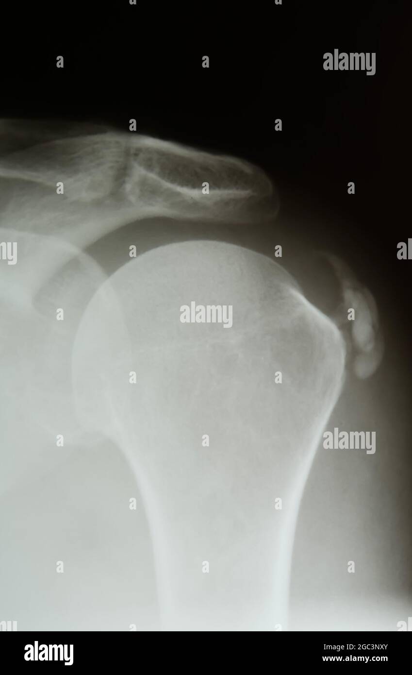 XRay image of calcified shoulder (Tendinosis calcarea Stock Photo Alamy