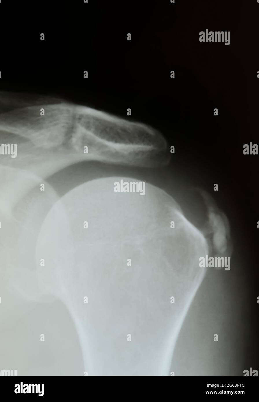 Shoulder injury calcification hires stock photography and images Alamy