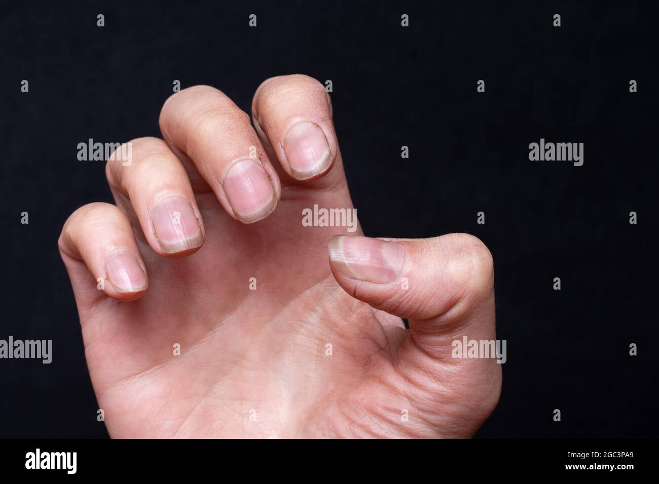 Close-up of female caucasian hand with dirty brittle nails, broken nails on a black background. Peeling on nails. Nail and hand care concept Stock Photo