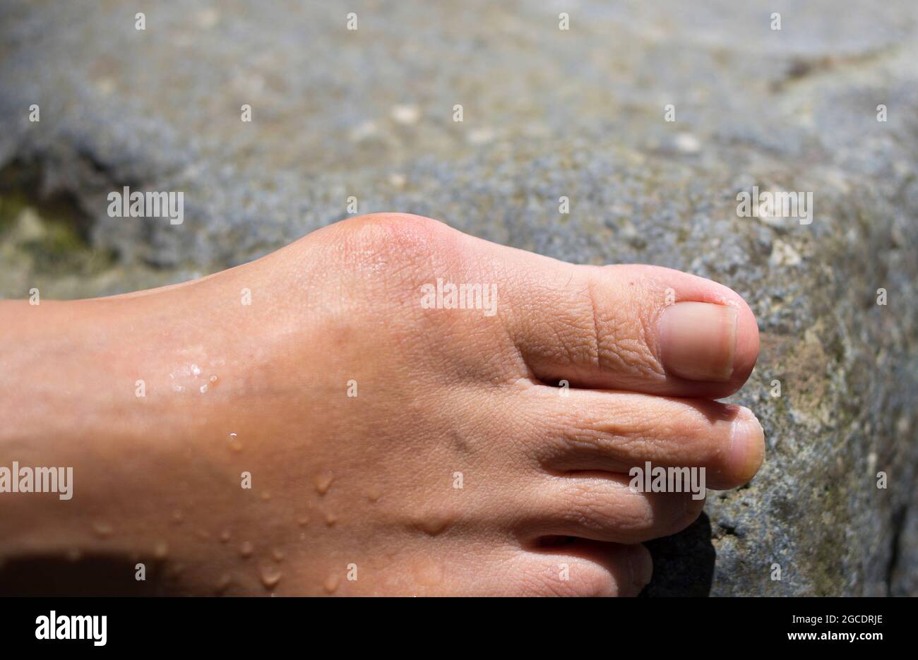 Bunions or Hallux valgus,  Middle-aged woman foot Stock Photo