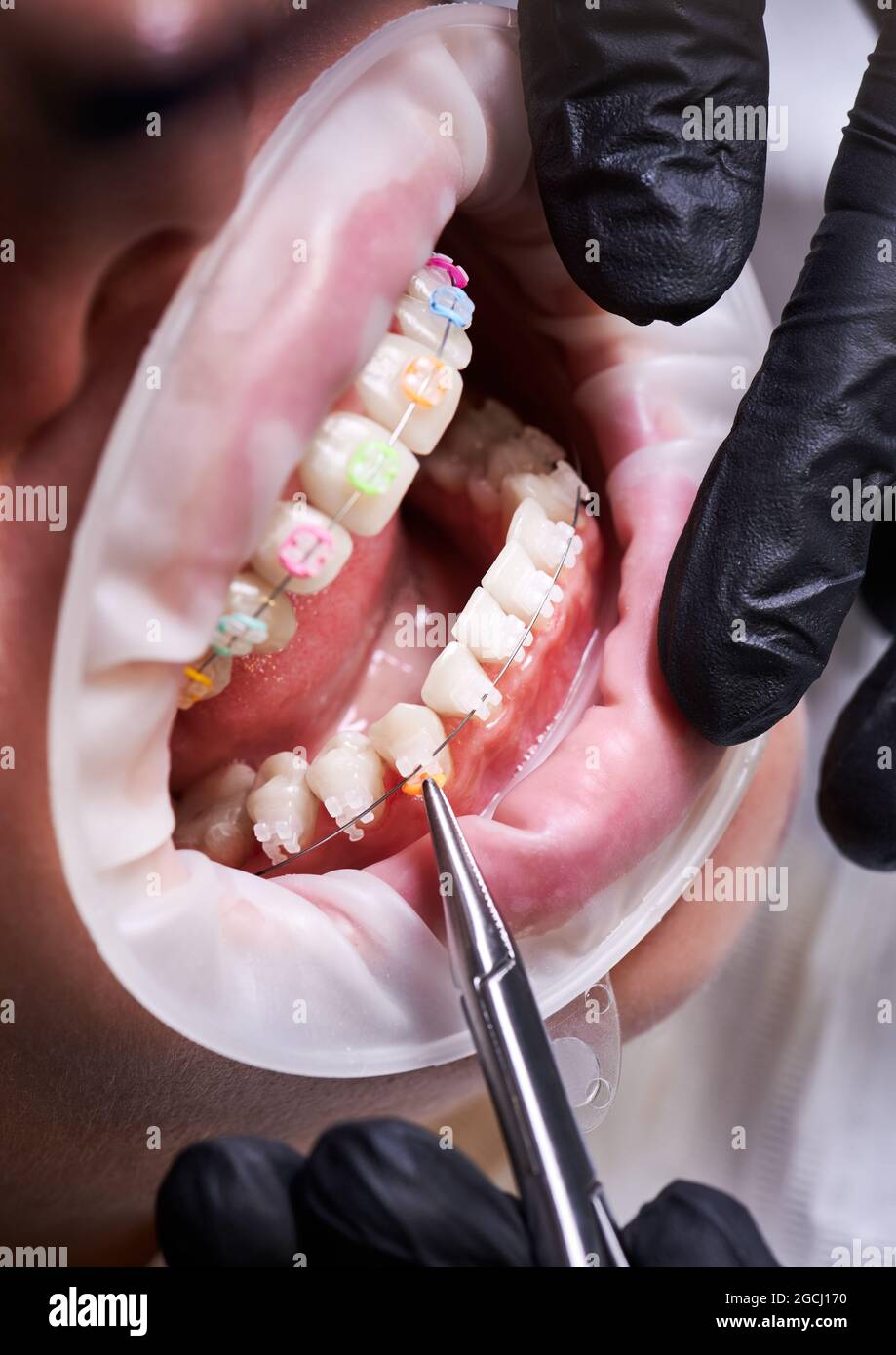 Dentist attaching ceramic braces and steel wire with a help of tongs. Close  up of person with cheek retractor and white teeth with braces having  orthodontic treatment in clinic. Concept of dentistry
