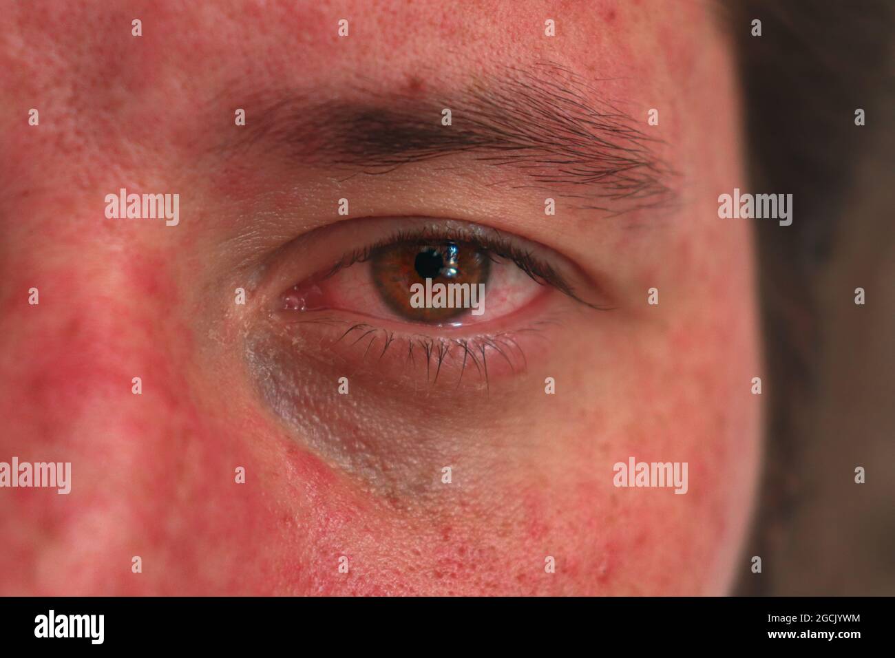 Caucasian male's face becomes red and itchy because of eczema Stock Photo