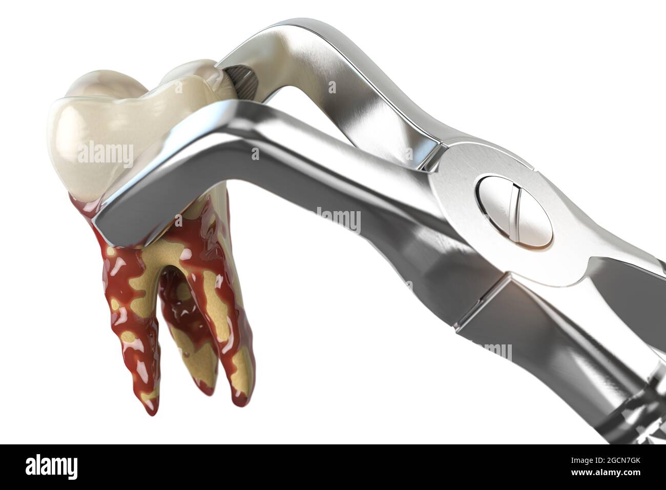 Tooth extraction with dental forceps isolated on white background. 3d