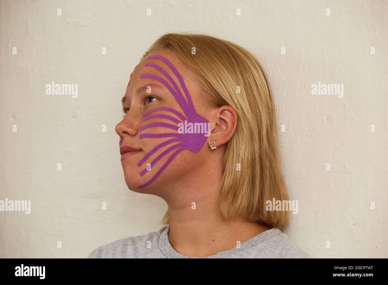 Girl's face in profile with kinesiological tapes for cheeks Stock Photo
