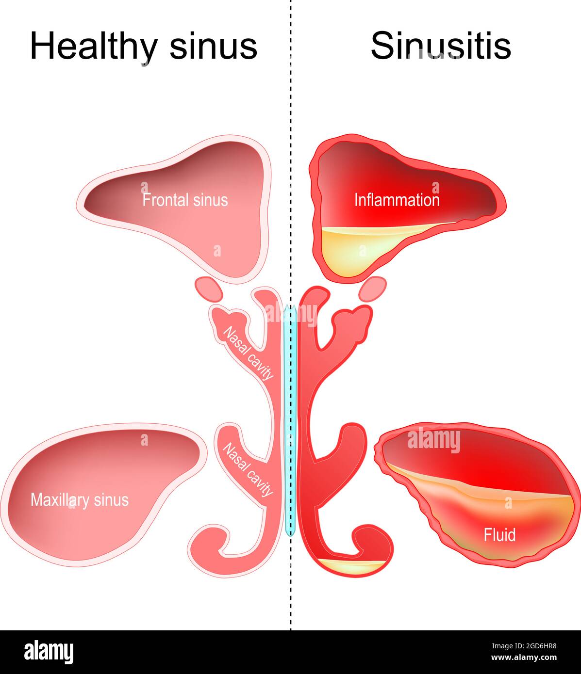 Sinusitis. Healthy nasal sinus and sinus with infection (inflammation and fluid). vector illustration Stock Vector