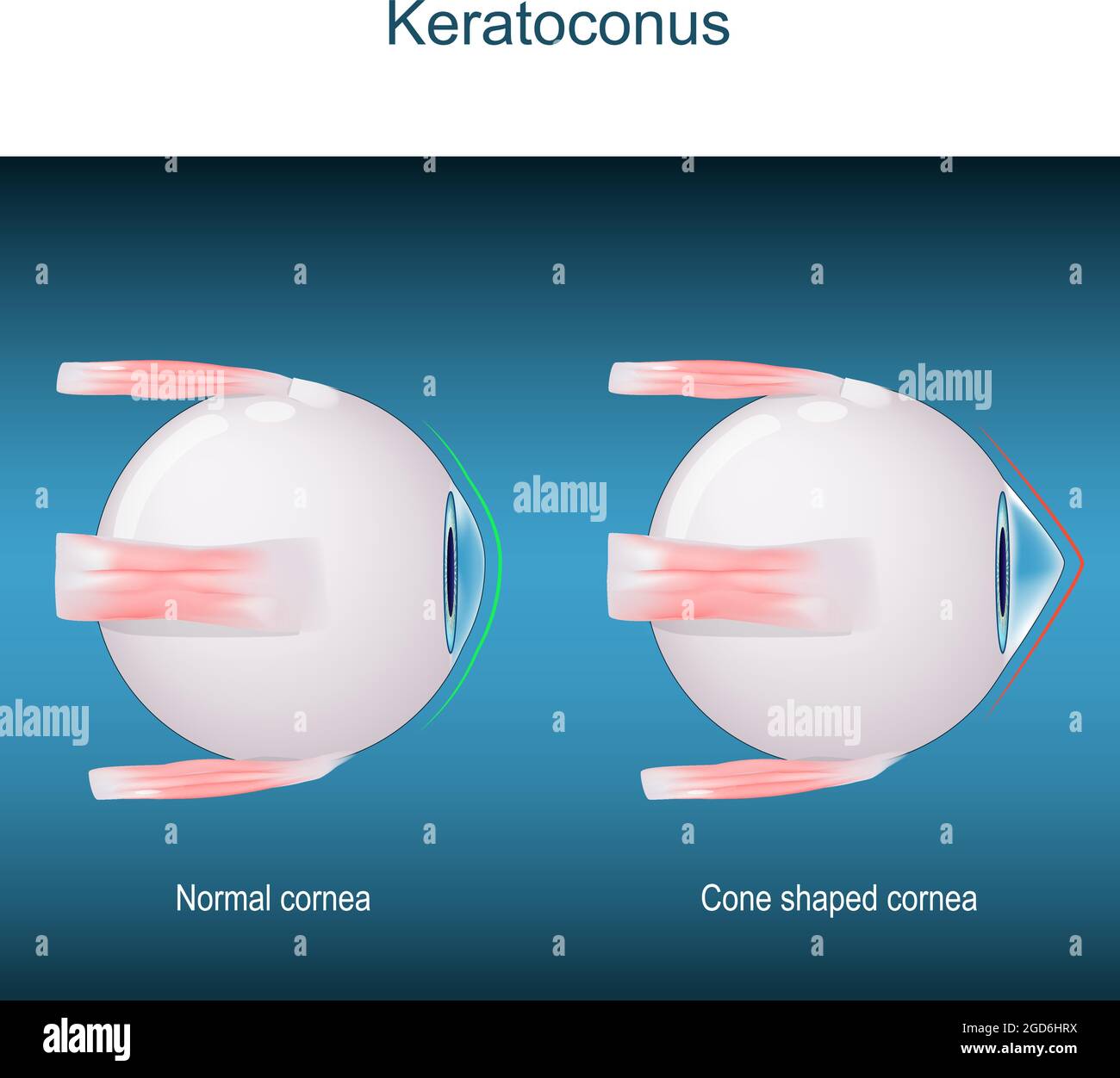 Keratoconus. disorder or disease of the eye. progressive thinning of the cornea. vector Stock Vector