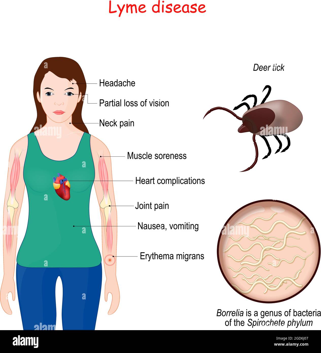 Lyme disease. Close-up of Deer tick. Magnification of Borrelia (bacteria of the Spirochete phylum). Woman with erythema, signs and symptoms Stock Vector