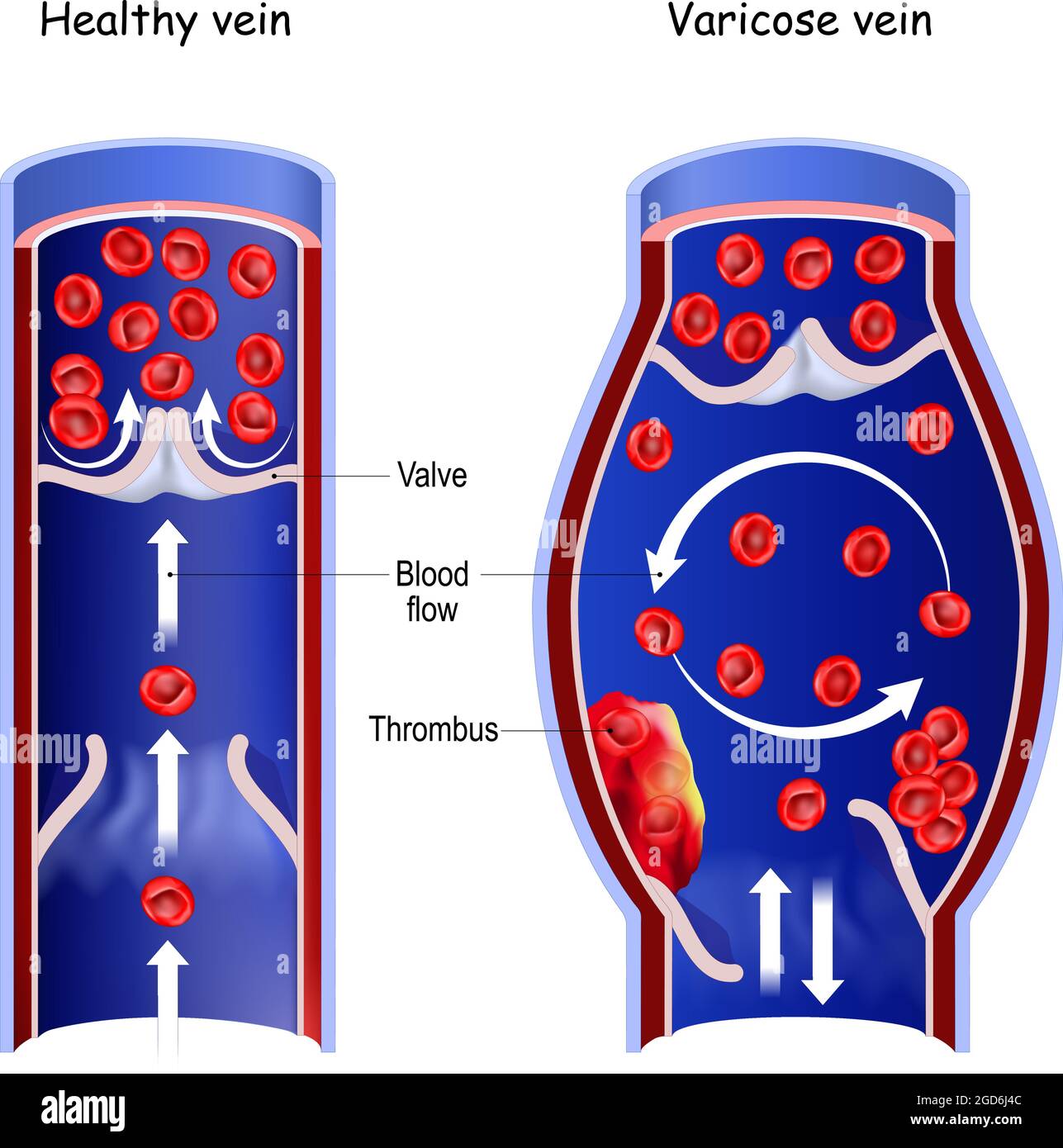 Healthy vein, and varicose vein. Cross section of normal blood vessel and thrombus in blood flow. vector illustration Stock Vector