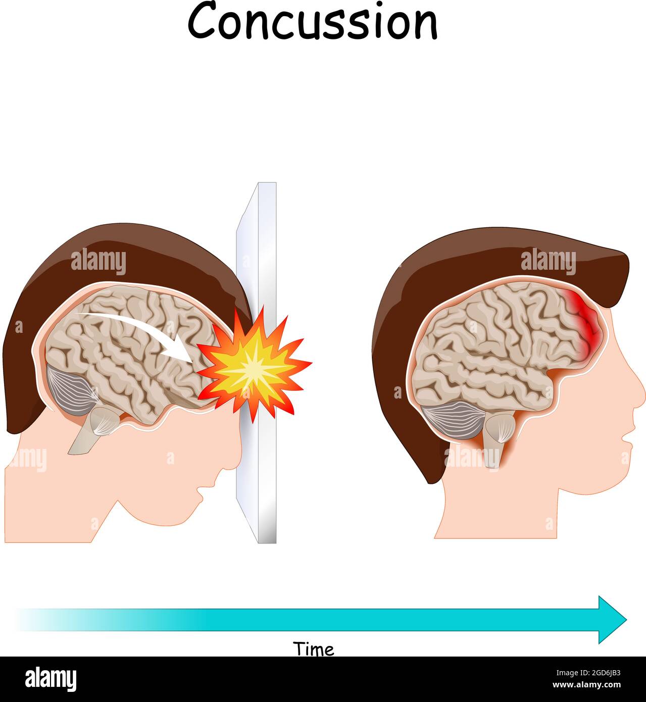 Concussion. Human's head. brain after head trauma. Vector illustration Stock Vector