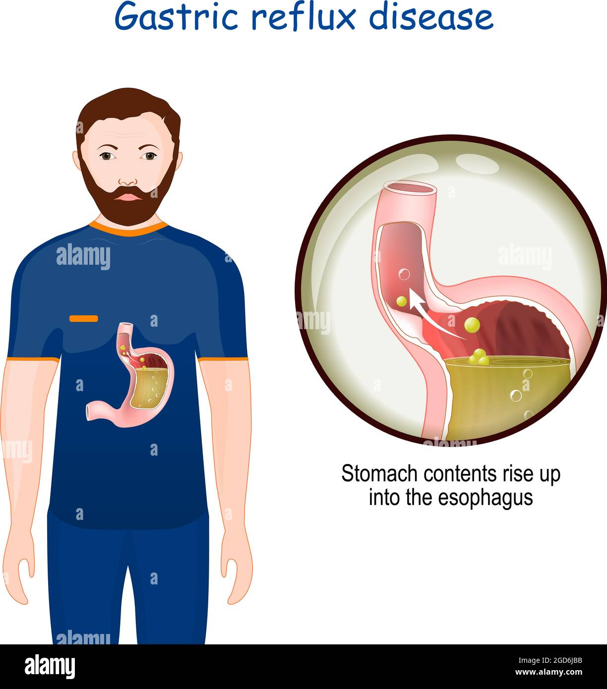 Gastroesophageal reflux disease. Close-up of stomach with GERD. chronic condition in which stomach contents rise up into the esophagus. human anatomy. Stock Vector