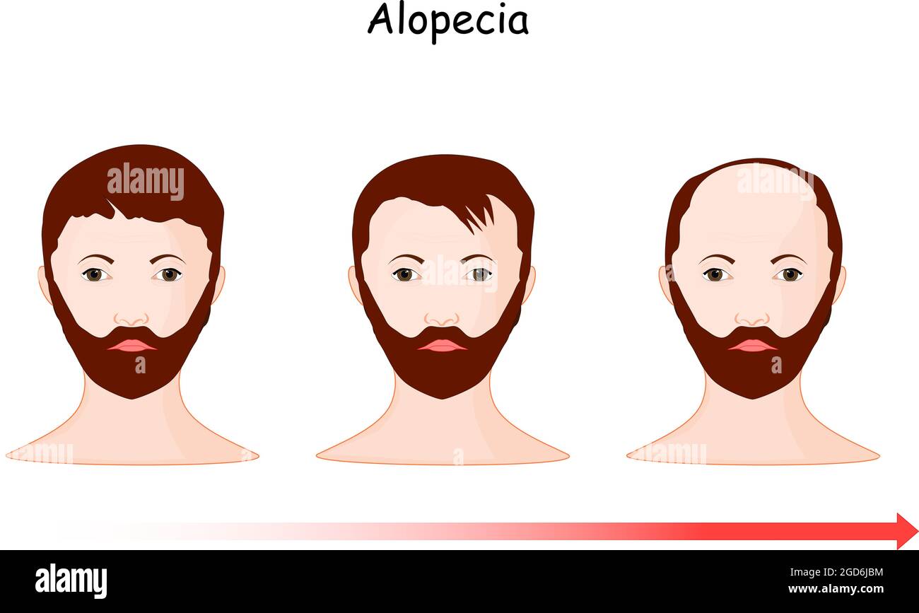 alopecia. baldness. hair loss from part of the head of a man along time. vector illustration human's head and time line Stock Vector