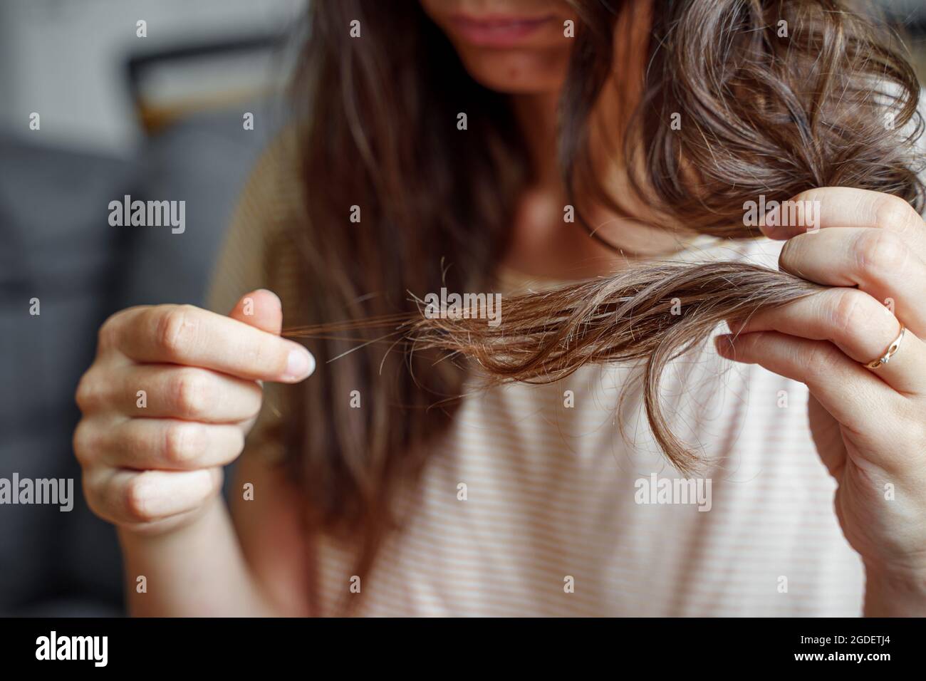 Young woman has hair loss problem. Loosing hair after covid disease. Care shampoo for repairing thin hair. Avitaminosis, anaemia problem  Stock Photo