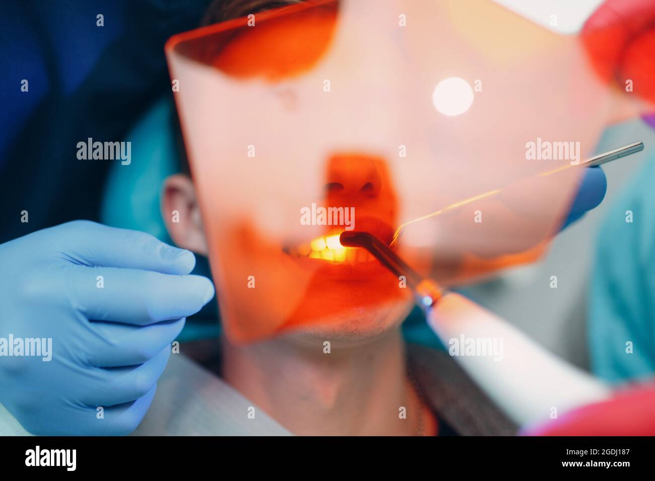 Dentistry. Dentist and patient. Light curing seal. UV dental lamp and orange protect glass. Dental fillings. Stock Photo