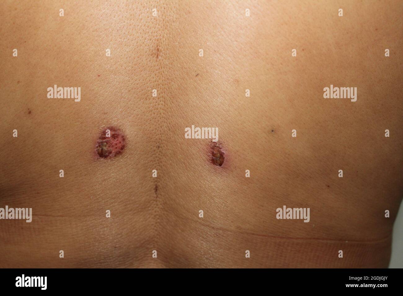 Two holes on a woman's upper back showing the liposuction or lipo entry points done during cosmetic surgery procedure Stock Photo