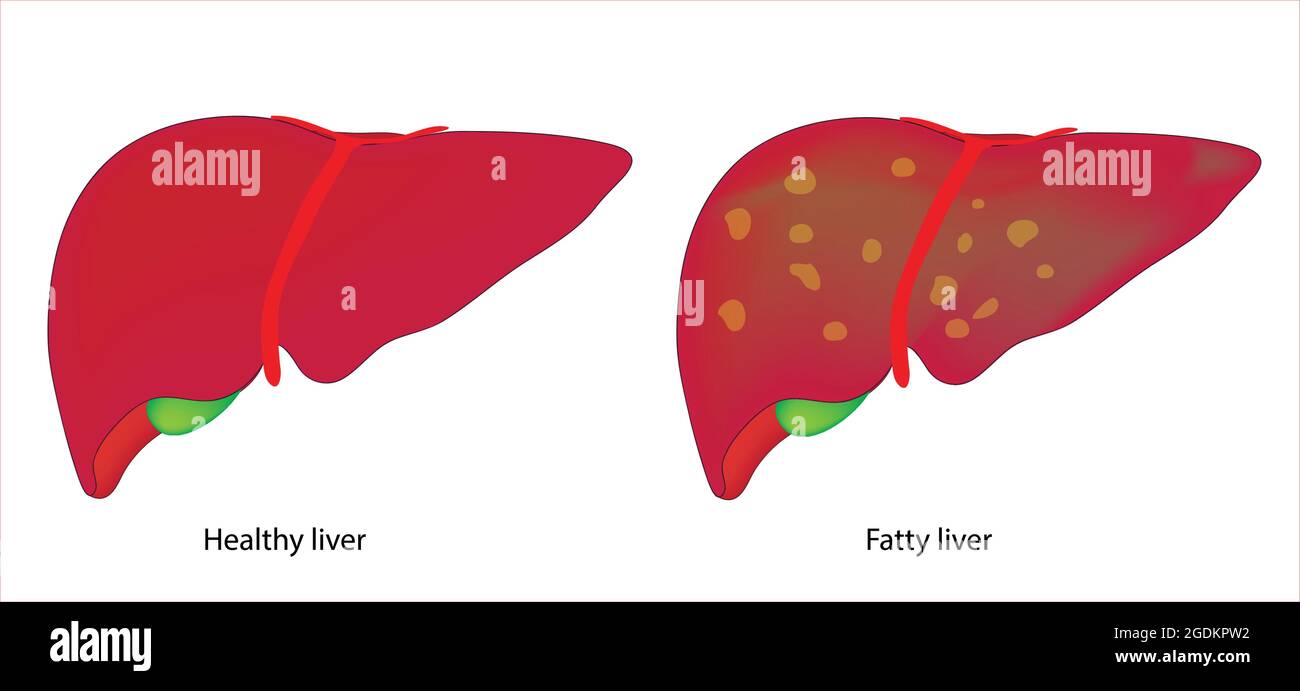 fatty liver and healthy liver, healthy liver and fatty liver, Fatty