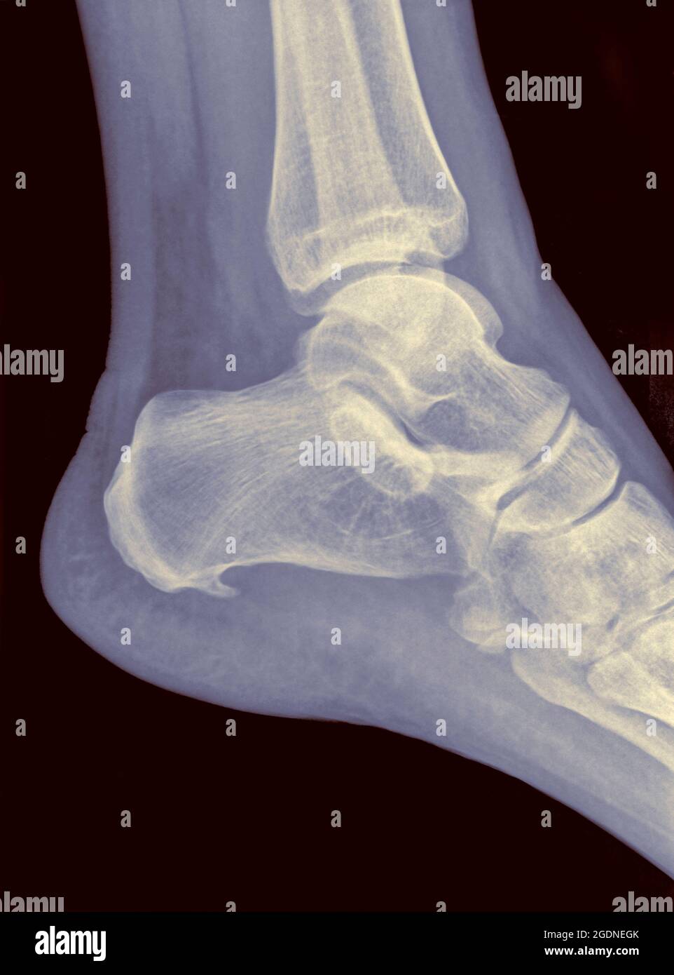 X-ray of a heel showing Plantar fasciitis (also known as Plantar fasciopathy or Jogger's heel) is a common painful enthesopathy of the heel and planta Stock Photo