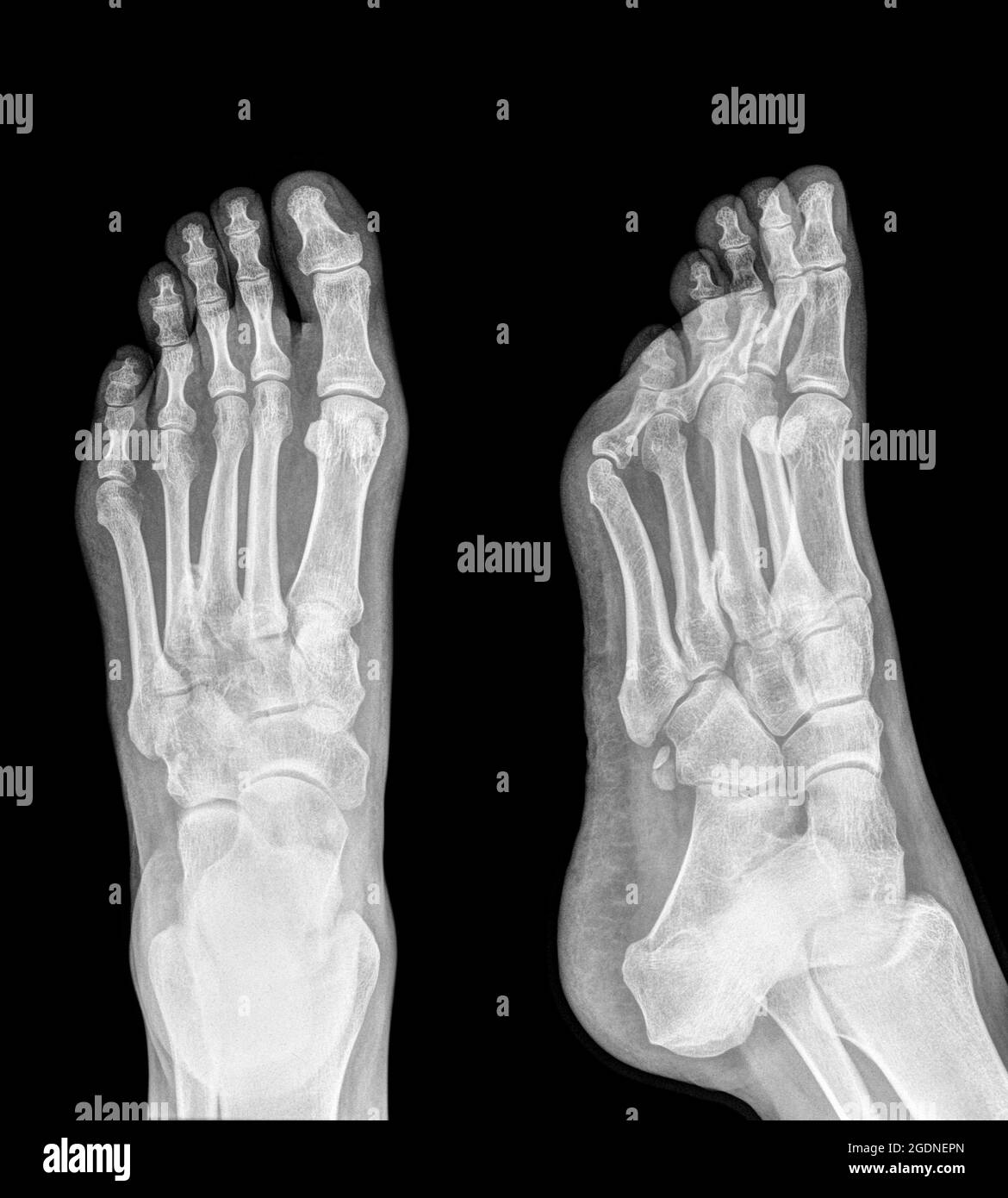 X-ray of a foot showing Plantar fasciitis (also known as Plantar fasciopathy or Jogger's heel) is a common painful enthesopathy of the heel and planta Stock Photo