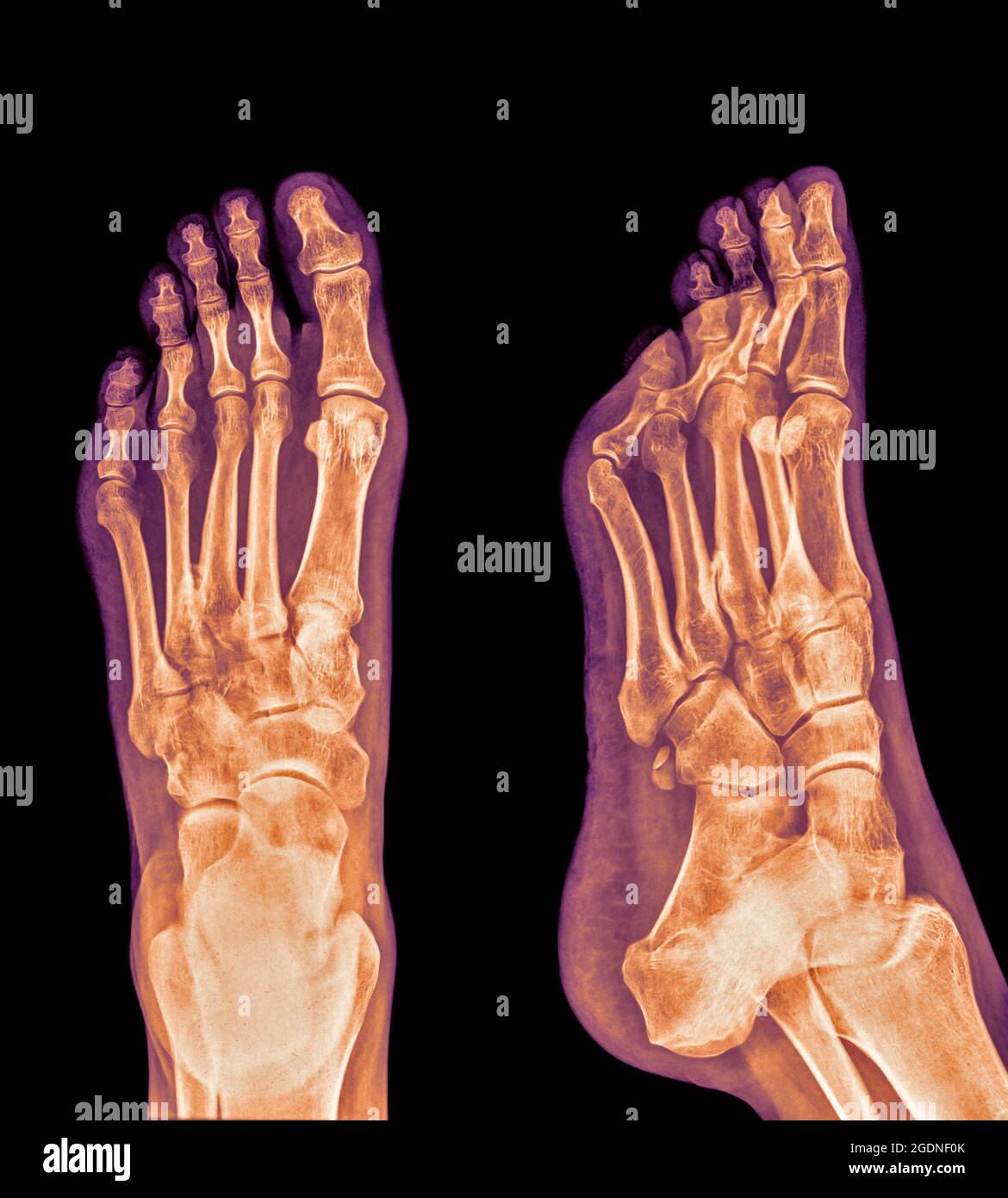 X-ray of a foot showing Plantar fasciitis (also known as Plantar fasciopathy or Jogger's heel) is a common painful enthesopathy of the heel and planta Stock Photo