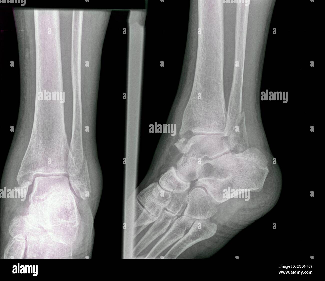 Fracture of the distal tibia and fibula. X-ray of a 57 year old male Stock Photo