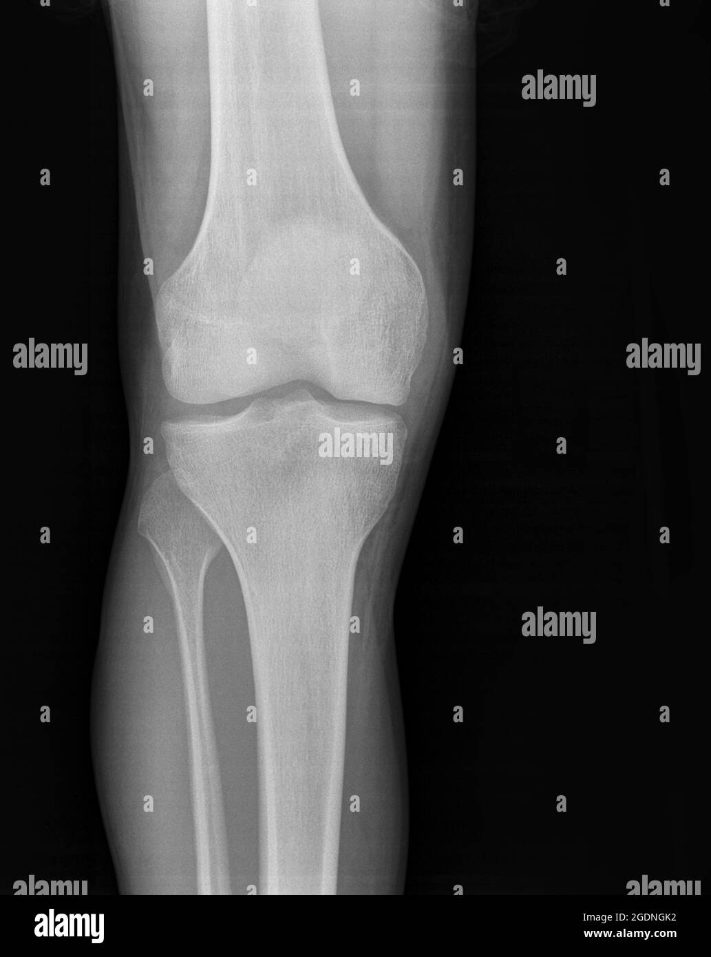 Synovitis of the right knee of a 27 year old male front view Stock Photo